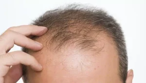 Androgenetische Alopezie – Eine umfassende Lösung durch Haarverpflanzung bei HTT (Haartransplantation Türkei)