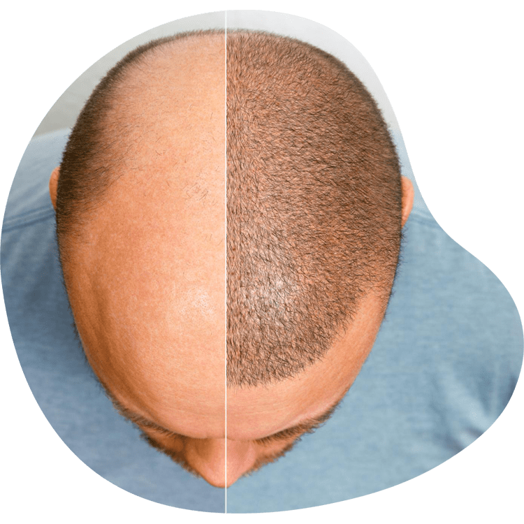 DHI Methode Haartransplantation Türkei Antalya